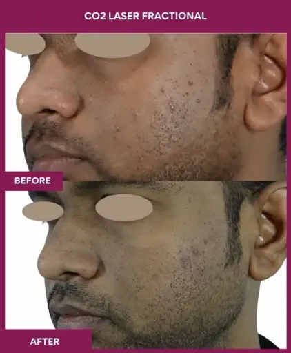 1 CO2 Laser Fractional (3)
