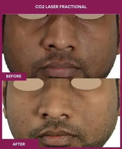 1 CO2 Laser Fractional