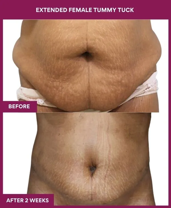 1 Extended Female Tummy Tuck_4_ (2)