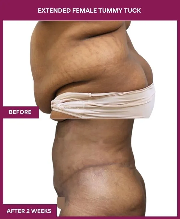 1 Extended Female Tummy Tuck_4_ (3)