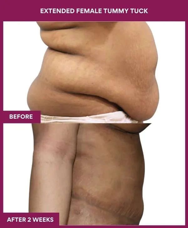 1 Extended Female Tummy Tuck_4_ (4)
