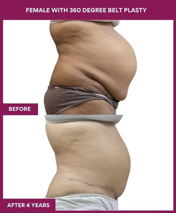 FEMALE WITH 360 DEGREE BELT PLASTY in Mumbai, India