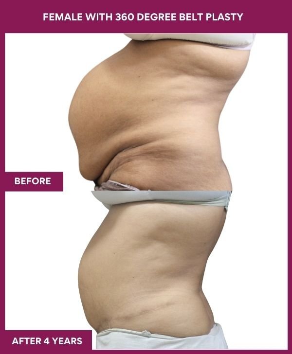 FEMALE WITH 360 DEGREE BELT PLASTY