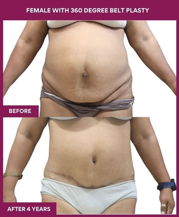 FEMALE WITH 360 DEGREE BELT PLASTY in Mumbai, India