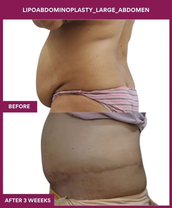 1 Lipoabdominoplasty_Large_Abdomen (5)_40_