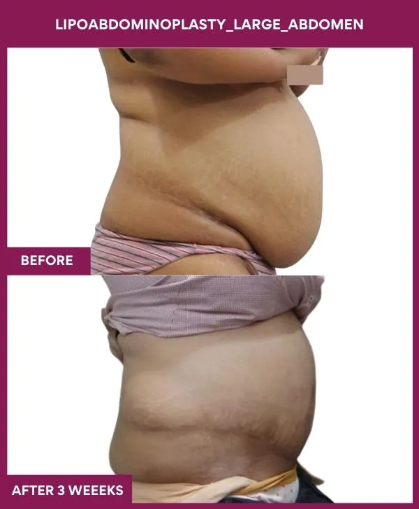 1 Lipoabdominoplasty_Large_Abdomen (6)_40_