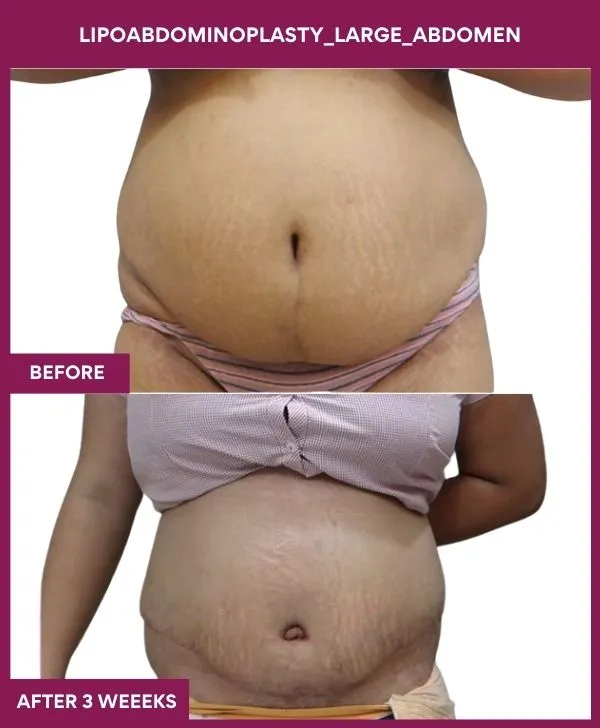 1 Lipoabdominoplasty_Large_Abdomen (7)_40_