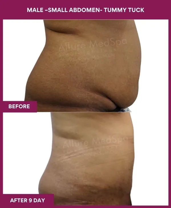 1 MALE –SMALL ABDOMEN- TUMMY TUCK (2)_7