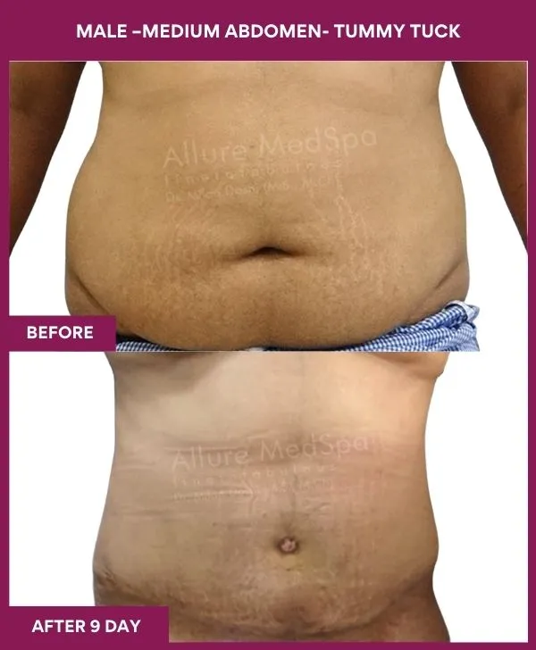 1 MALE –SMALL ABDOMEN- TUMMY TUCK (4)_9