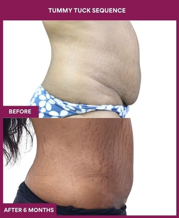 1 TUMMY TUCK SEQUENCE (2)