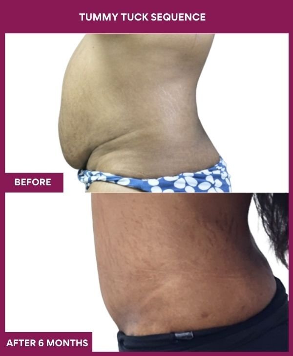 1 TUMMY TUCK SEQUENCE (3)