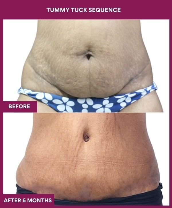 1 TUMMY TUCK SEQUENCE