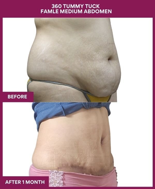 11 360 TUMMY TUCK FAMLE MEDIUM ABDOMEN (2)