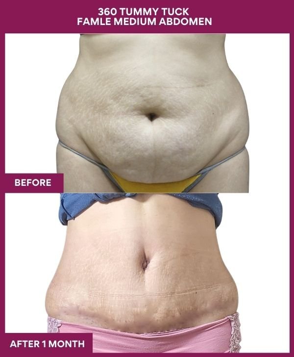 11 360 TUMMY TUCK FAMLE MEDIUM ABDOMEN
