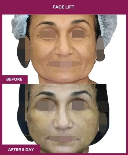 12 FACE LIFT_29_ (1)