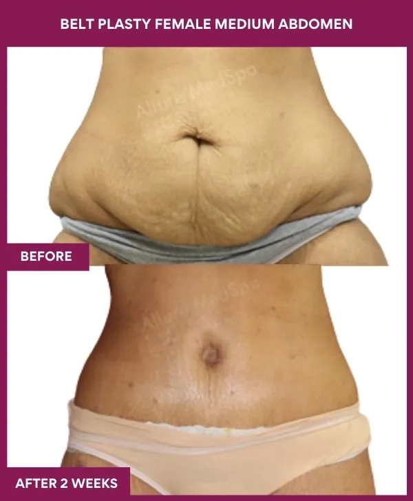 2 BELT PLASTY FEMALE MEDIUM ABDOMEN (4)_13_