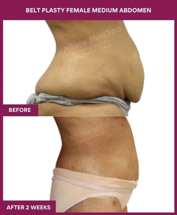 2 BELT PLASTY FEMALE MEDIUM ABDOMEn (2)_13_