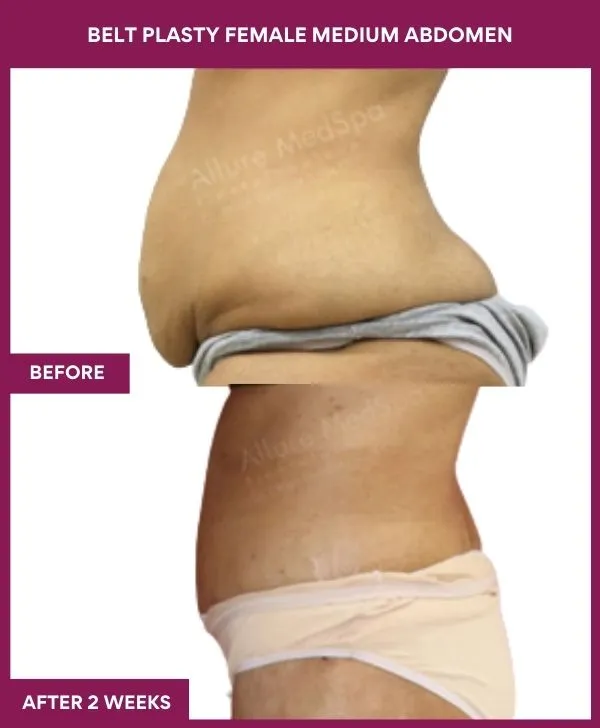 2 BELT PLASTY FEMALE MEDIUM ABDOMEn (3)_13_