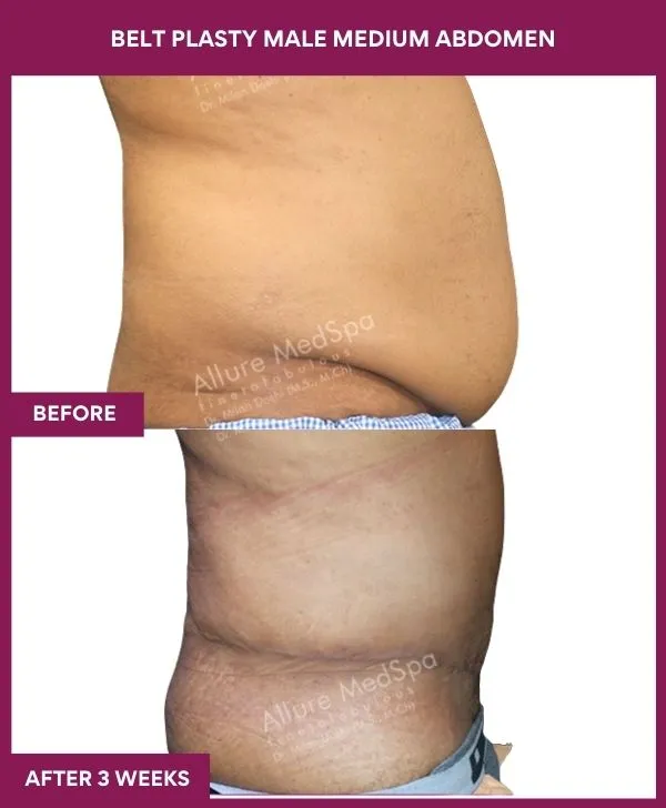 2 BELT PLASTY MALE MEDIUM ABDOMEn (2)_16_