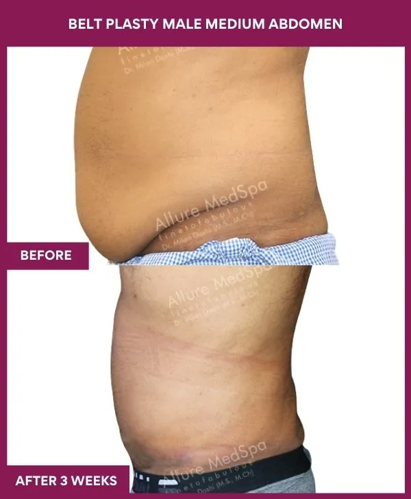 2 BELT PLASTY MALE MEDIUM ABDOMEn (3)_16_