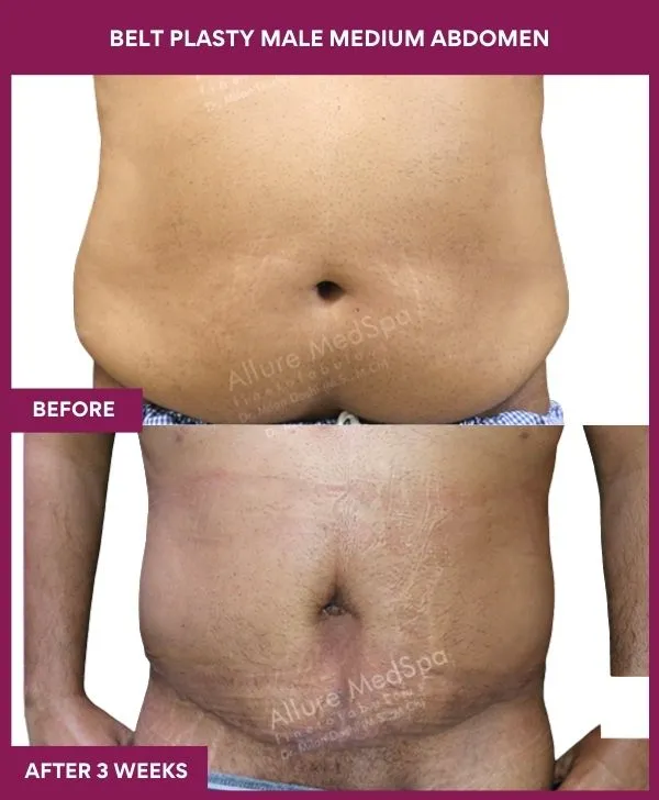 2 BELT PLASTY MALE MEDIUM ABDOMEn (4)_16_