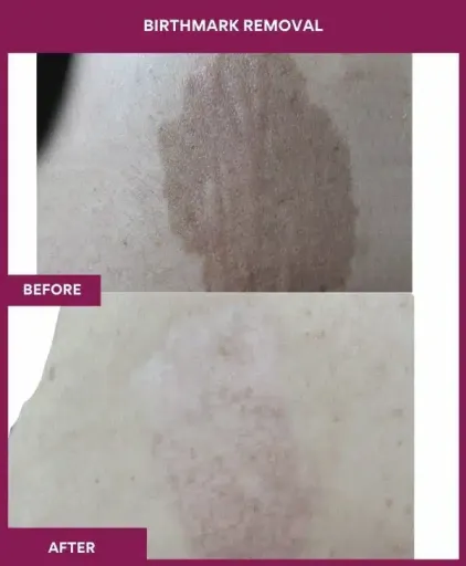 2 BIRTHMARK REMOVAL