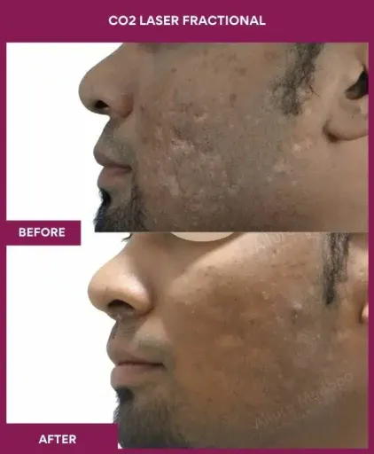 2 CO2 Laser Fractional (2)