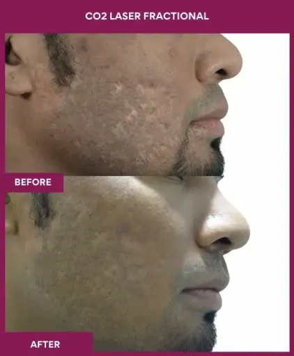 2 CO2 Laser Fractional (3)