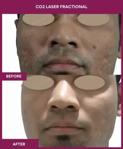 2 CO2 Laser Fractional
