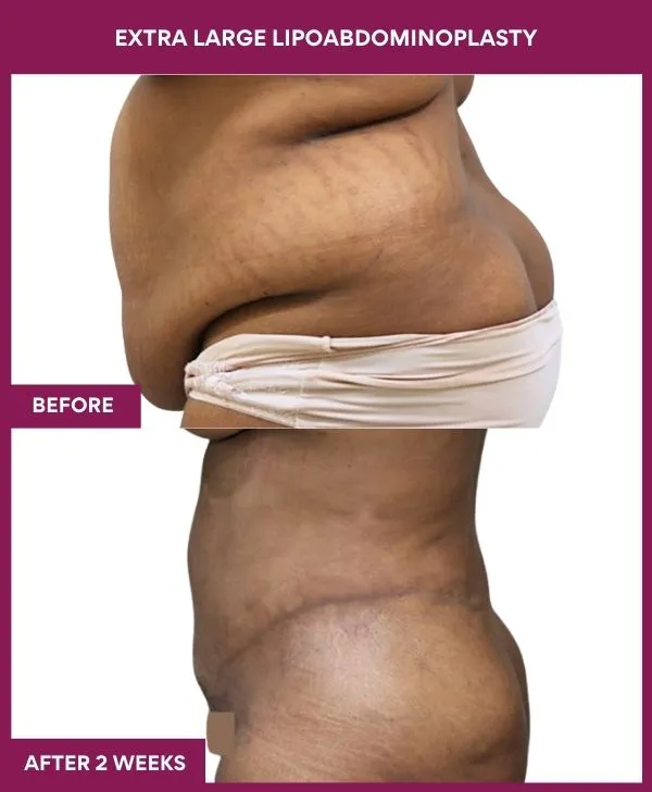 2 EXTRA LARGE LIPOABDOMINOPLASTY (6)_47_