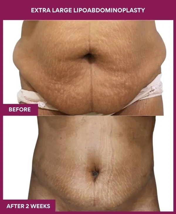 2 EXTRA LARGE LIPOABDOMINOPLASTY (8)_47_