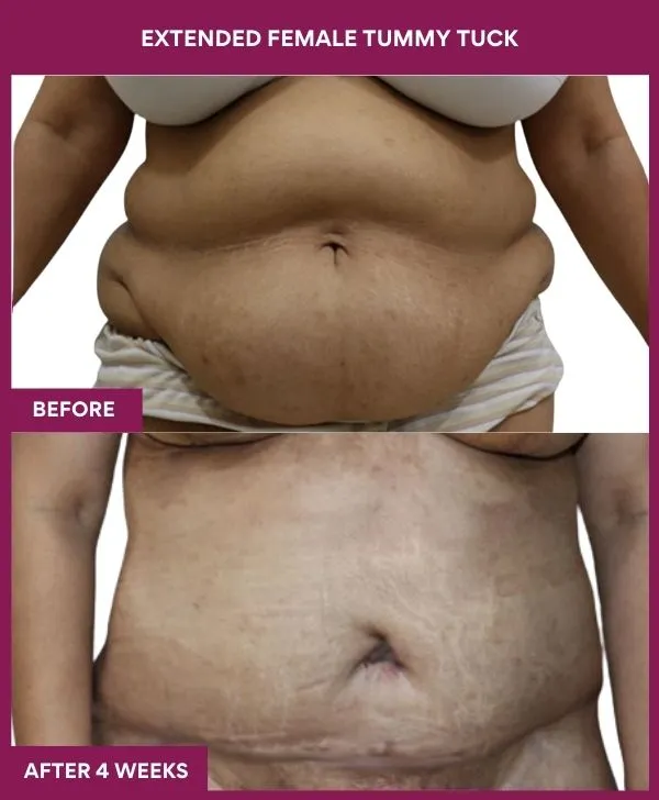 2 Extended Female Tummy Tuck_29_1 (1)