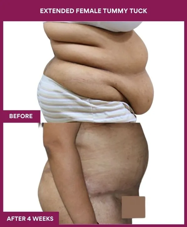 2 Extended Female Tummy Tuck_29_1 (2)