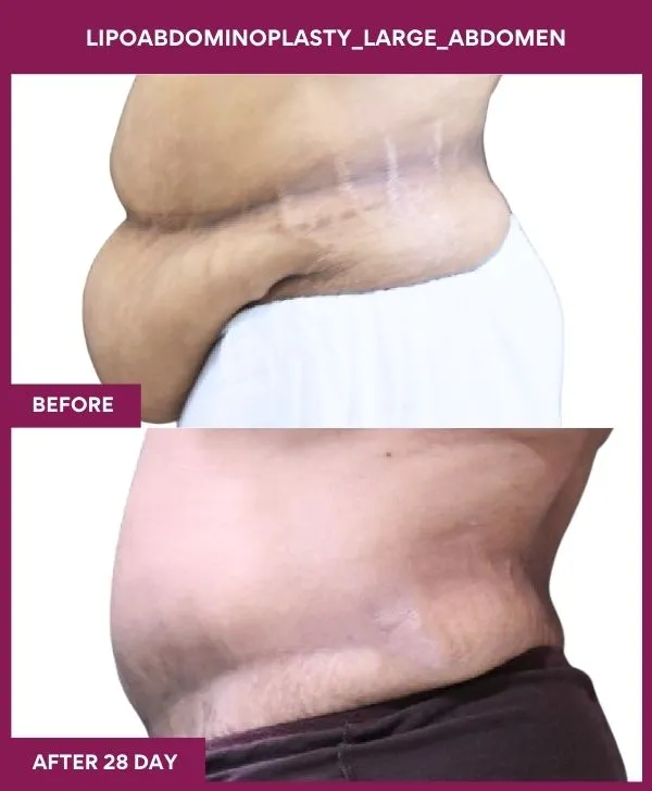 _ 2 Lipoabdominoplasty_Large_Abdomen_51_ (2)