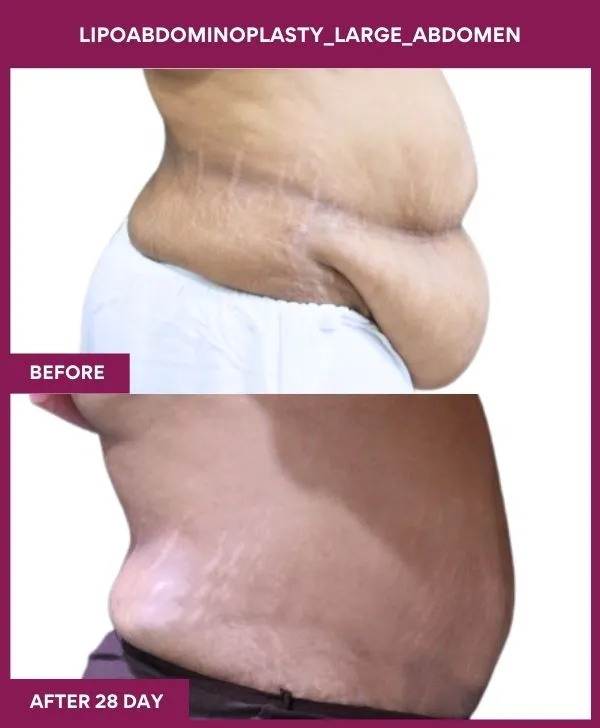 _ 2 Lipoabdominoplasty_Large_Abdomen_51_ (3)