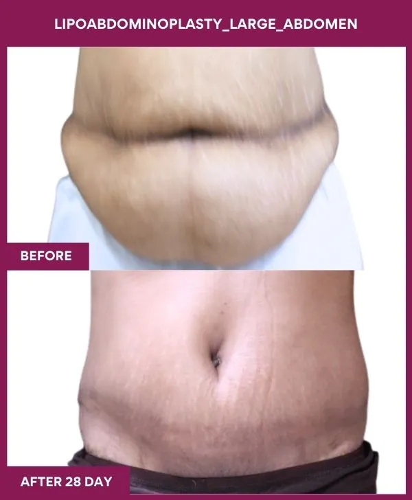_ 2 Lipoabdominoplasty_Large_Abdomen_51_ (4)