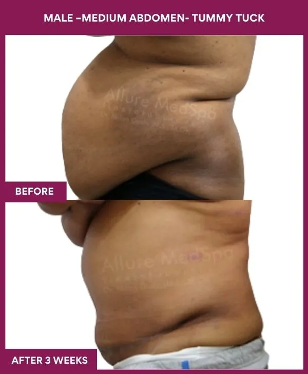 2 MALE –Medium ABDOMEN- TUMMY TUCK (2)_19