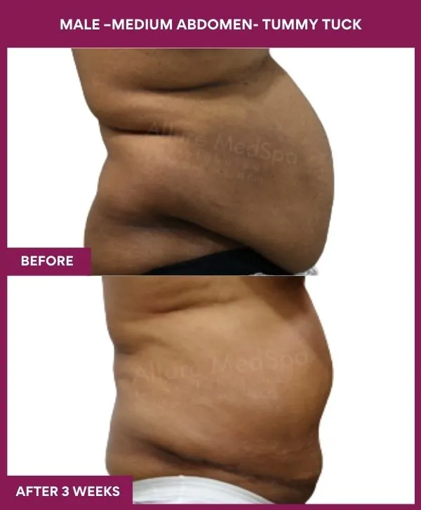 2 MALE –Medium ABDOMEN- TUMMY TUCK (3)_20