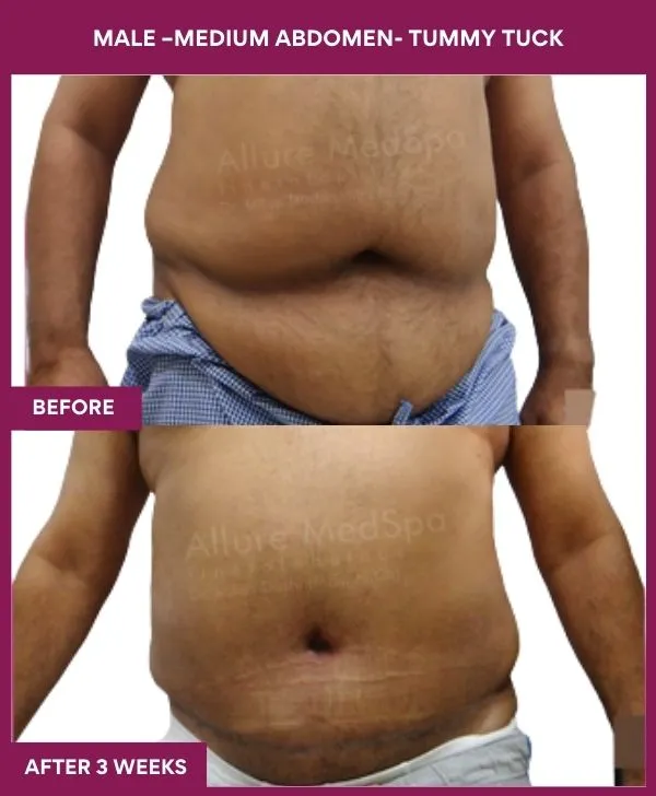 2 MALE –Medium ABDOMEN- TUMMY TUCK_21