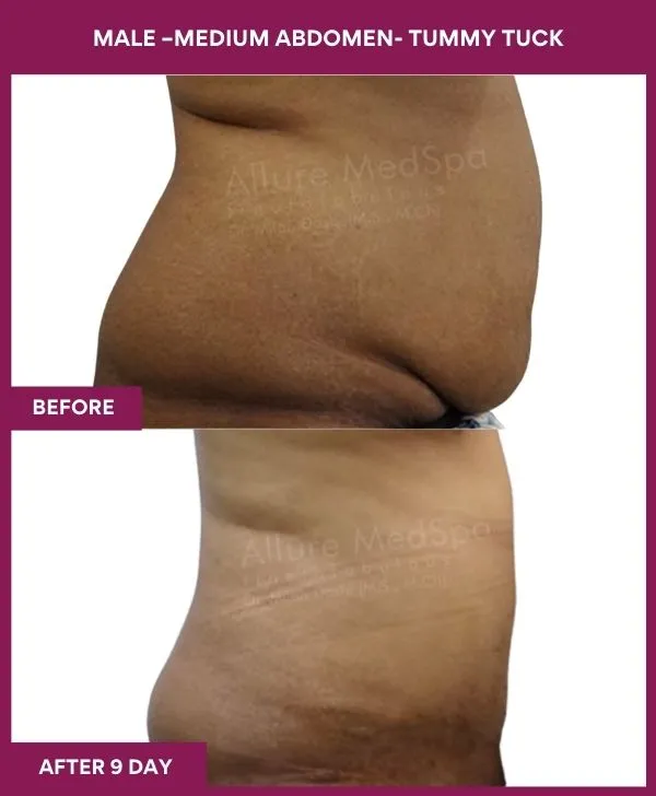 2 MALE –SMALL ABDOMEN- TUMMY TUCK_12 (2)