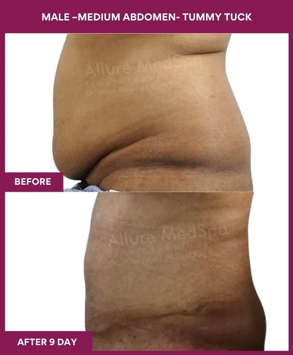 2 MALE –SMALL ABDOMEN- TUMMY TUCK_12 (3)