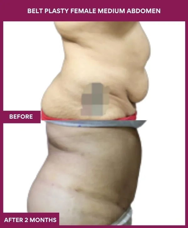 3 BELT PLASTY FEMALE MEDIUM ABDOMEn (2)_25_