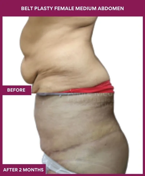 3 BELT PLASTY FEMALE MEDIUM ABDOMEn (3)_25_