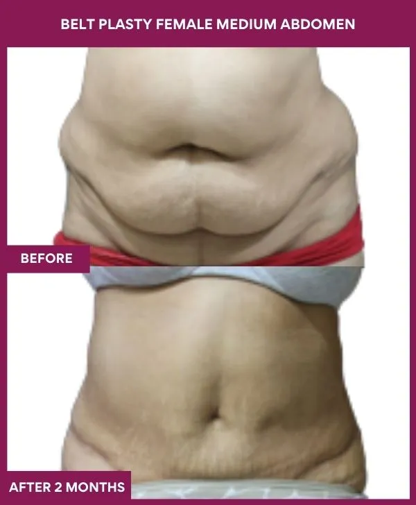 3 BELT PLASTY FEMALE MEDIUM ABDOMEn (4)_25_