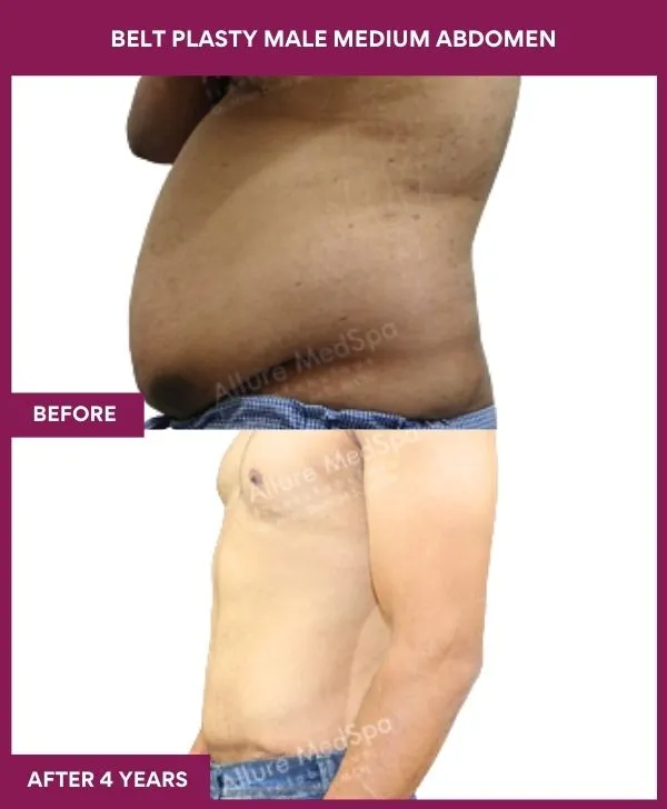 3 BELT PLASTY MALE MEDIUM ABDOMEn (3)_29_