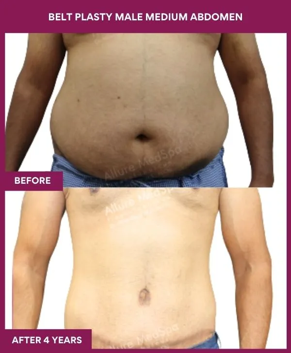 3 BELT PLASTY MALE MEDIUM ABDOMEn (4)_29_