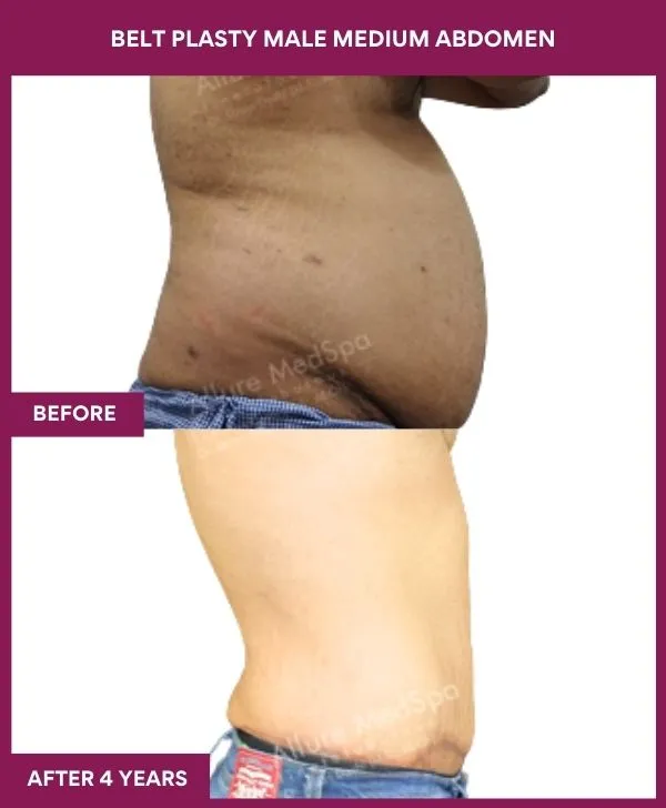 3 BELT PLASTY MALE MEDIUM ABDOMEn (5)_29_