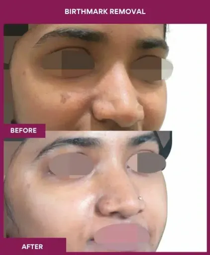 3 BIRTHMARK REMOVAL (2)