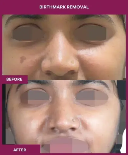 3 BIRTHMARK REMOVAL