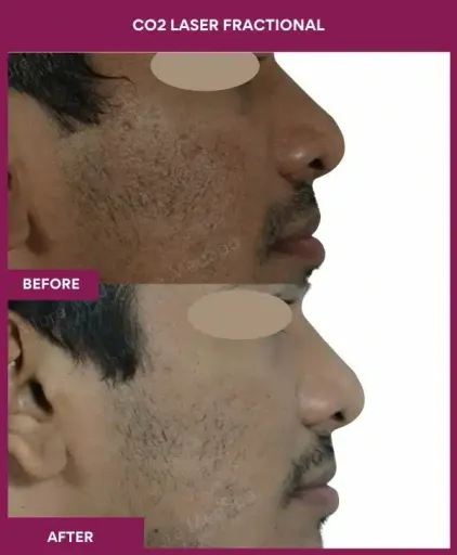 3 CO2 Laser Fractional (3)